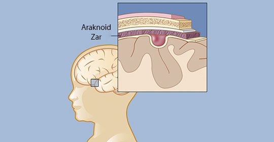 araknoid kist nedir nasil teshis edilir prof dr orhan sen